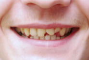 Dentes anteriores fraturados