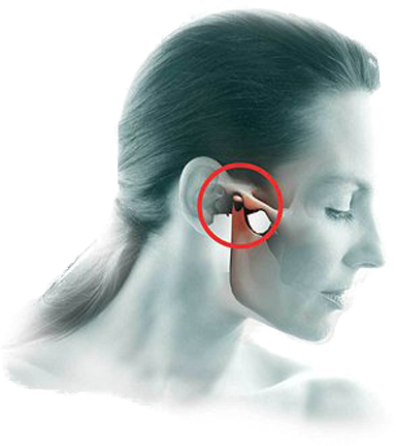 Disfunção da articulação temporomandibular (ATM).